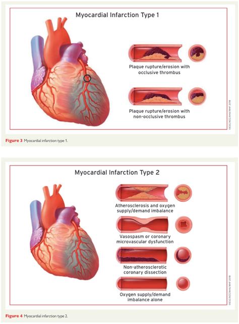 myocardial infarction definition